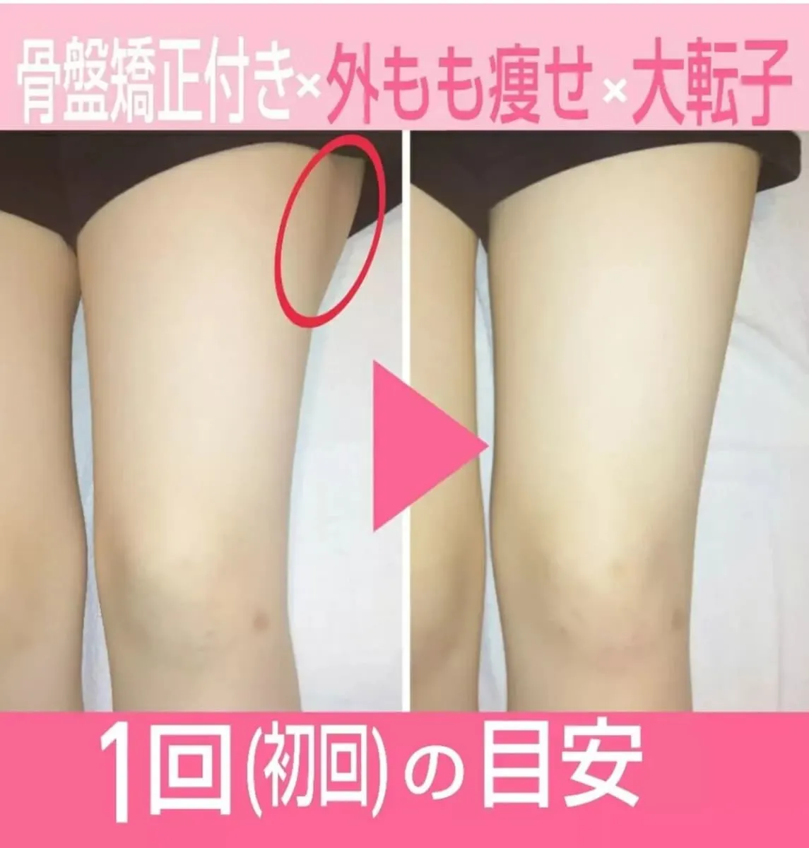 施術前後の外ももから大転子まわりの比較写真。初回の変化