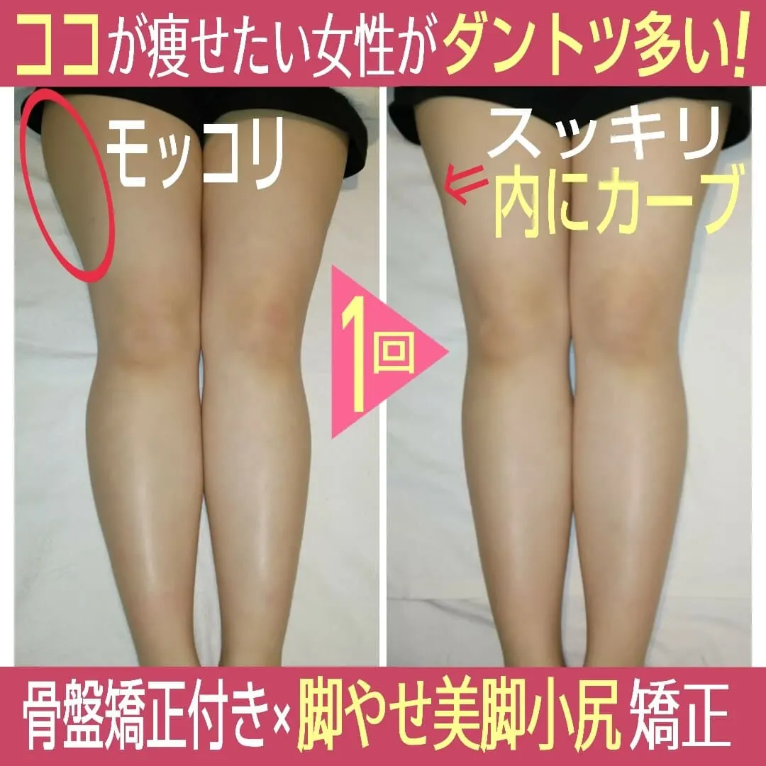 施術前後の太ももとお尻まわりの比較写真。赤丸で示した1回目の変化