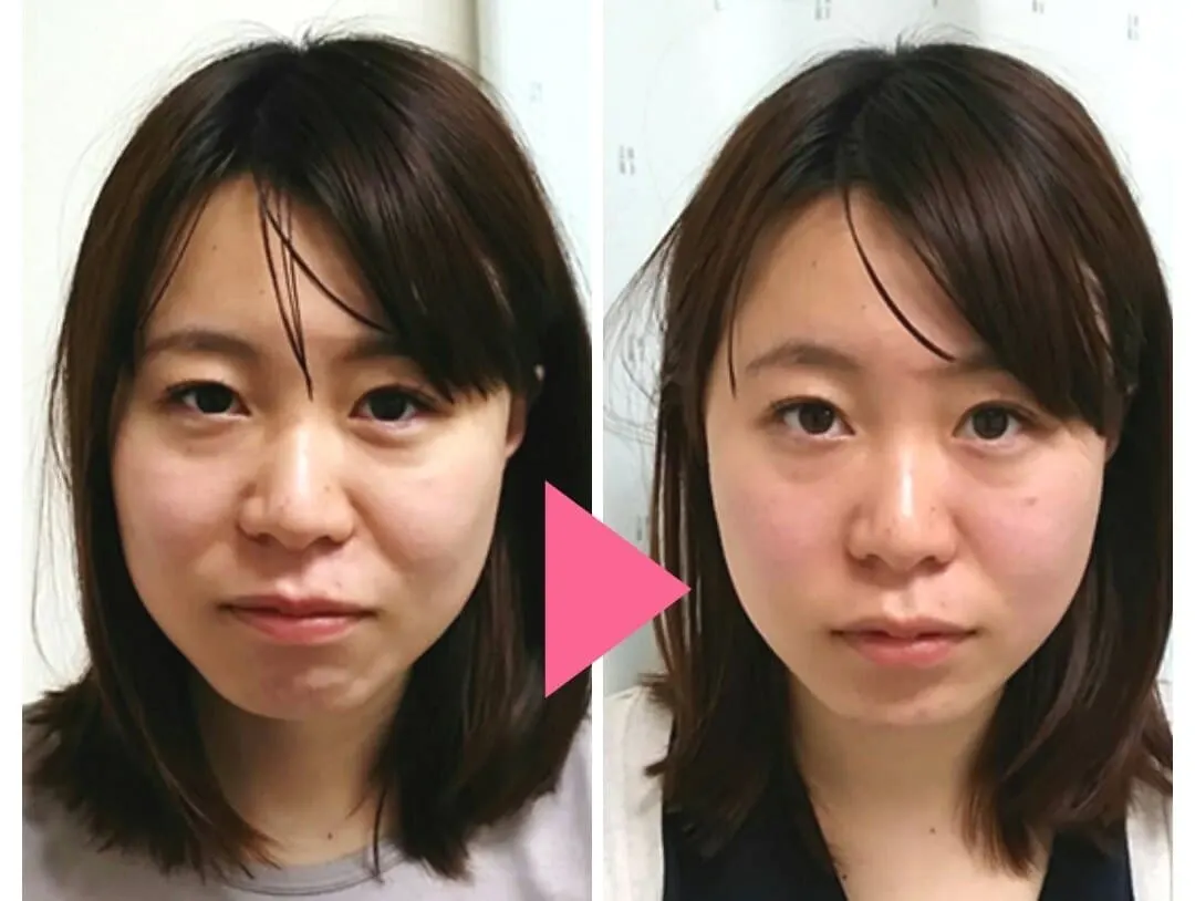 施術前後の顔まわりの比較写真。小顔矯正で顔のラインを整えた変化