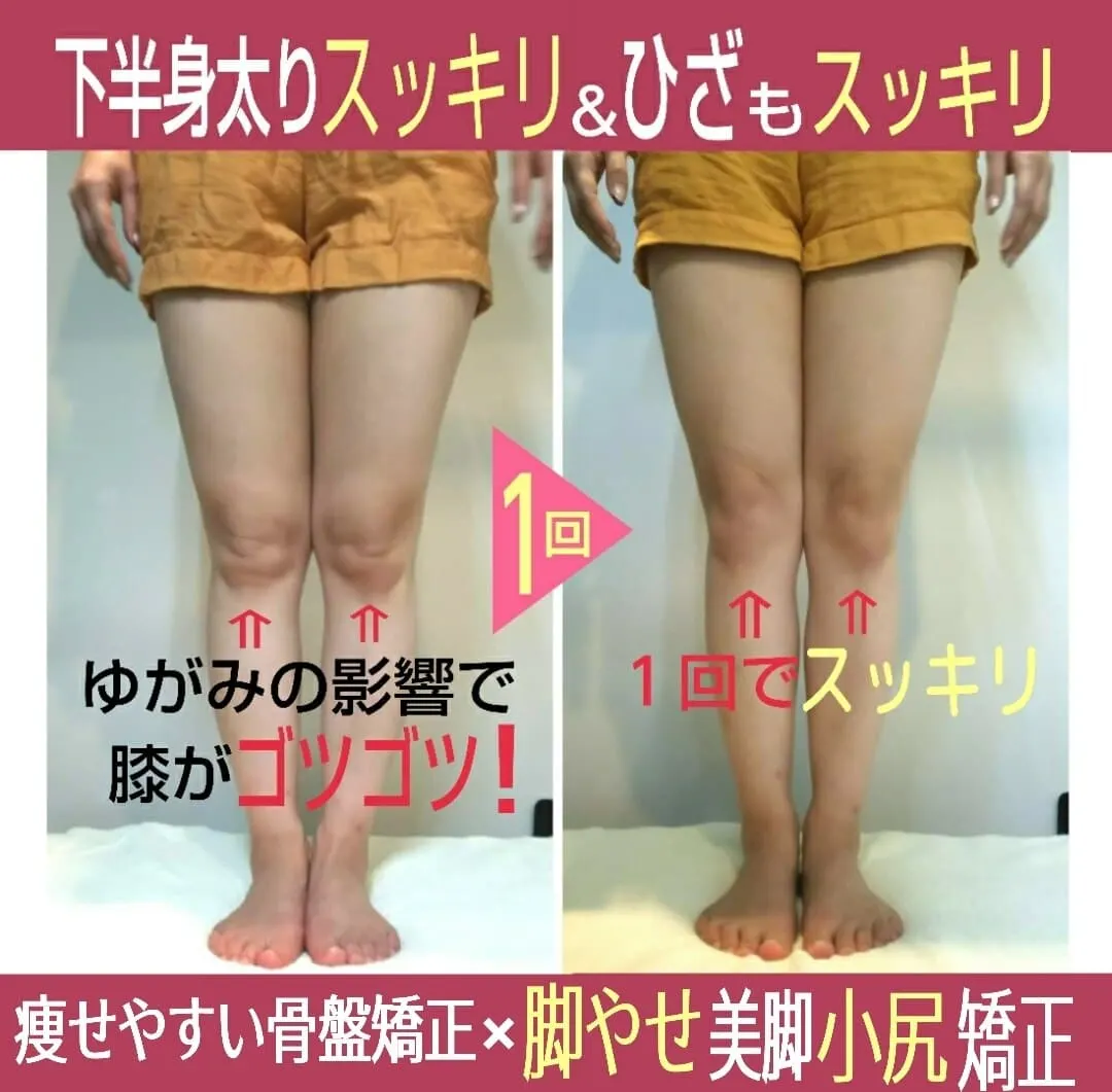 施術前後の脚の比較写真。膝まわりの1回目の変化