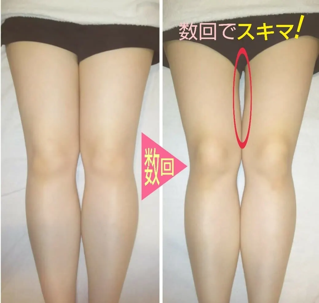 施術前後の脚の比較写真。数回の施術で内ももにすき間ができた変化