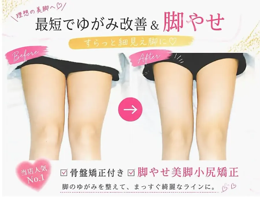 美脚フルコースの施術前後。脚のすき間とラインの変化を並べて確認できます