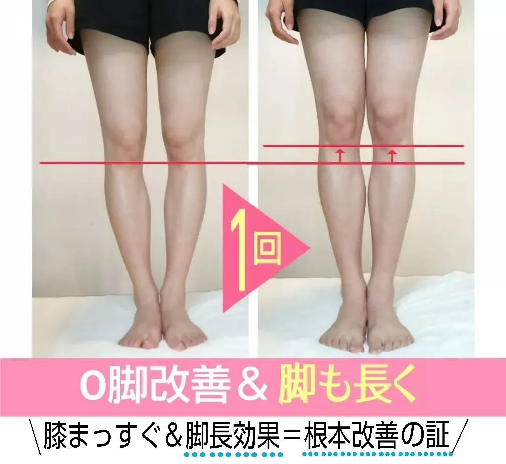 O脚ケアの施術前後の比較写真。1回で膝がまっすぐに