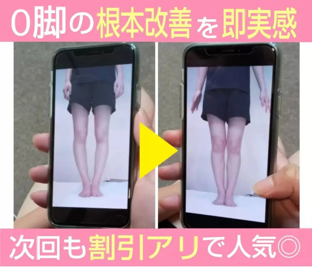 O脚ケアの施術前後の比較写真。スマホ画面での比較