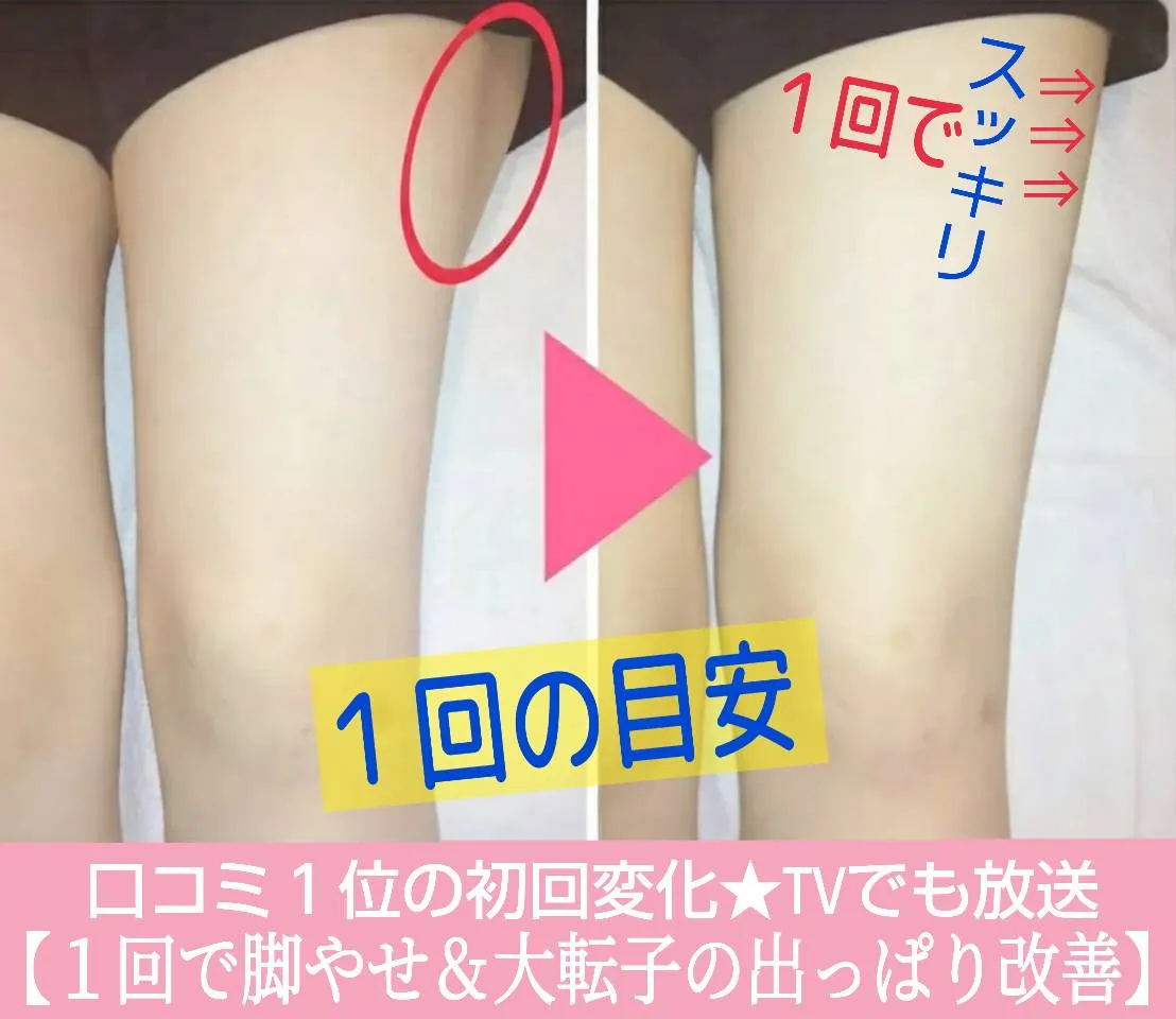 太ももの施術前後の比較写真。「口コミ１位の初回変化」「１回で脚やせ＆大転子の出っぱり改善」のバナー付き