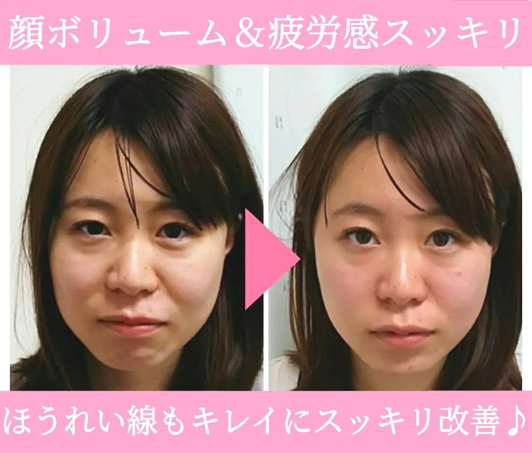 小顔矯正の施術前後の比較写真。ボリュームと疲労感がすっきりして顔のラインが整った様子