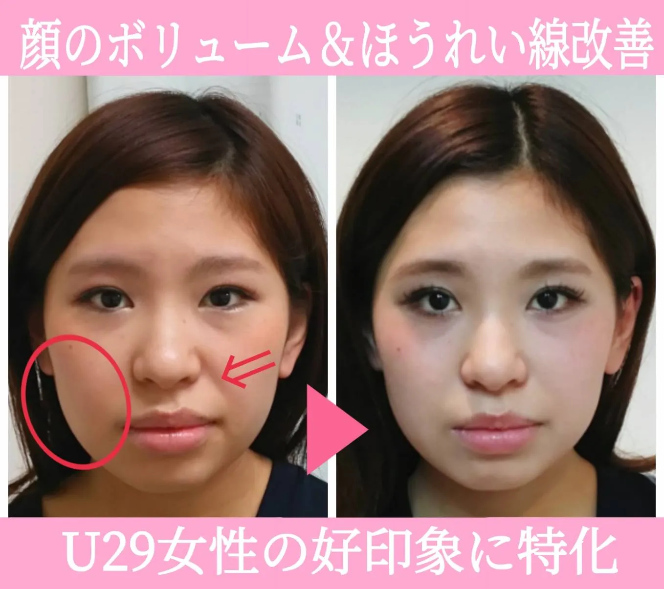 小顔矯正の施術前後の比較写真。ほうれい線のケアで表情が明るくなった様子