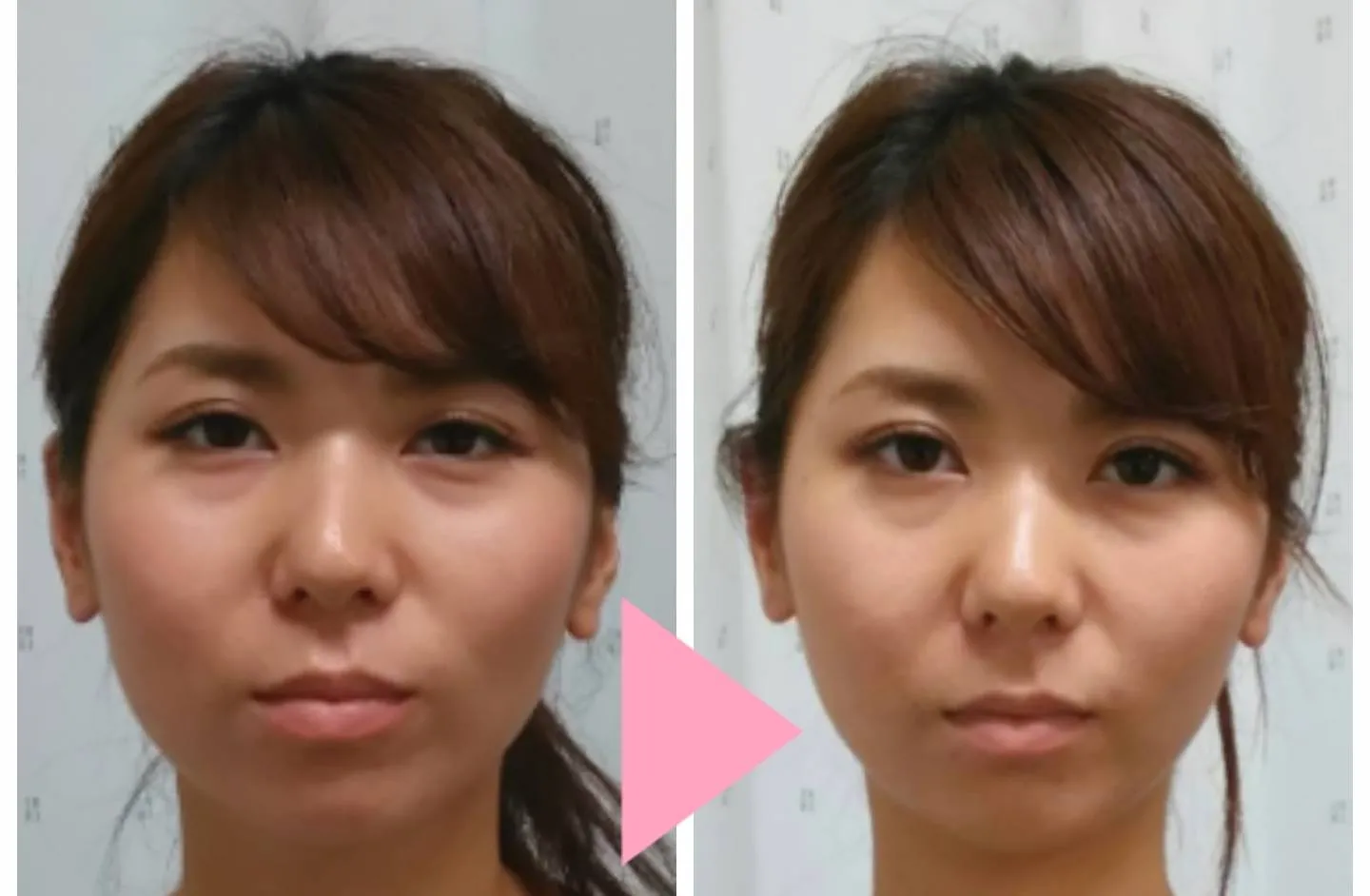施術前後の顔の正面比較写真。小顔矯正でフェイスラインがすっきり整った変化
